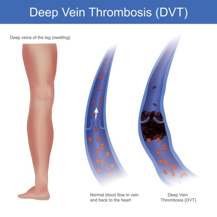 Deep Vein Thrombosis (dvt)