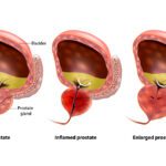 Prostate Enlargement Bph