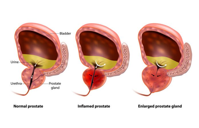 Prostate Enlargement Bph