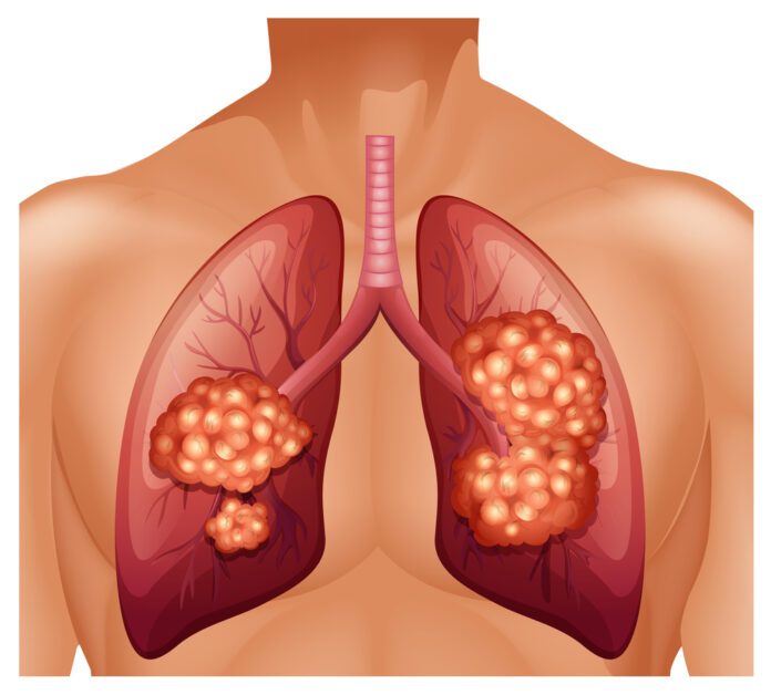 Stage 4 Lung Cancer (alk)