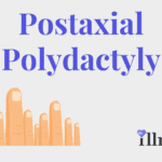 Postaxial Polydactyly
