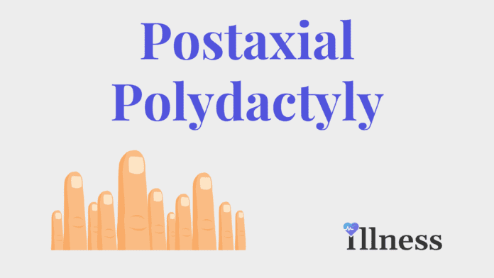 Postaxial Polydactyly