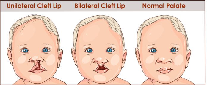 Cleft Lip And Cleft Palate