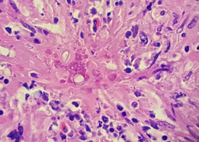 Giant Cell Glioblastoma, Astrocytoma
