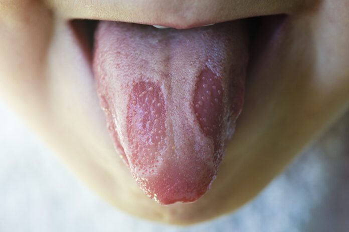 Geographic Tongue
