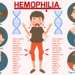 Hemophilia B
