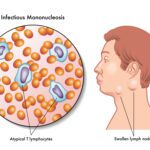 Mono (Infectious Mononucleosis)
