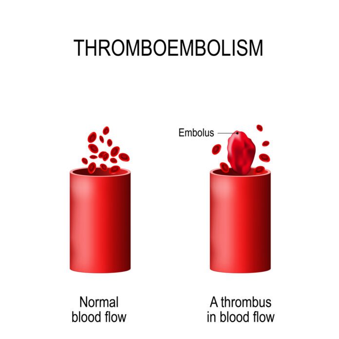 Purpura, Thrombotic Thrombocytopenic