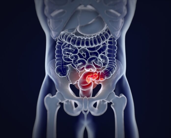 Small Intestine Cancer