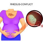 Rh Sensitization During Pregnancy