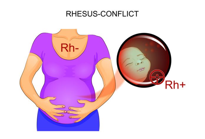 Rh Sensitization During Pregnancy