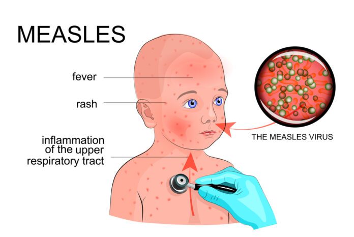 Rubella (Measles)