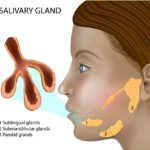 Salivary Gland Infection