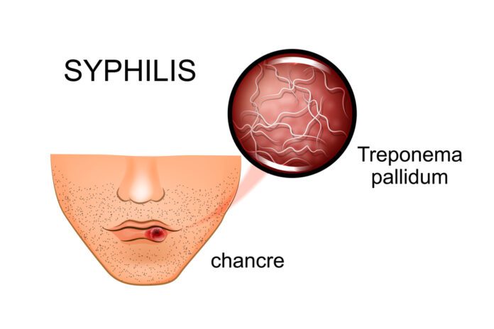 Syphilis, Congenital