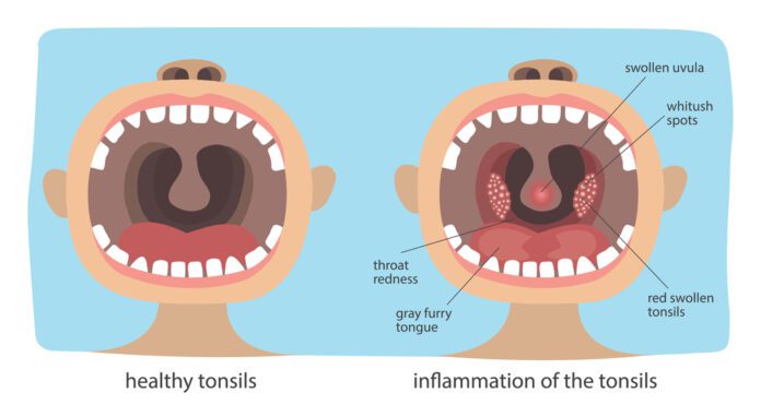 Sore Throat - Tonsillitis