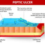 Ulcer, Peptic