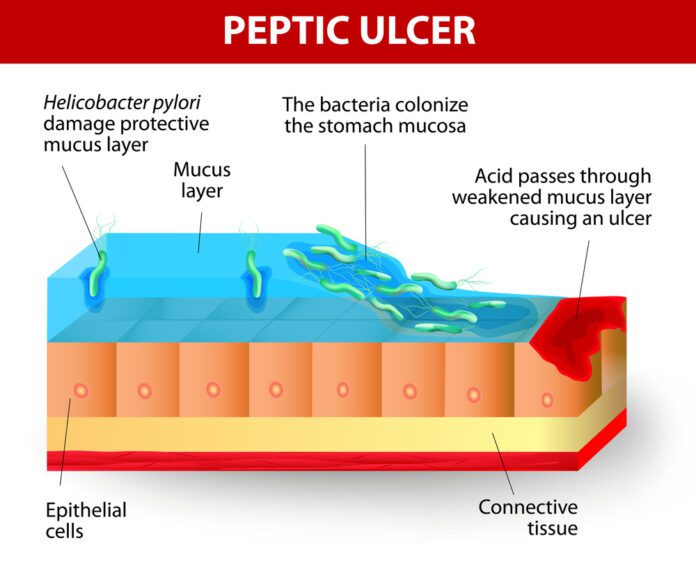 Ulcer, Peptic