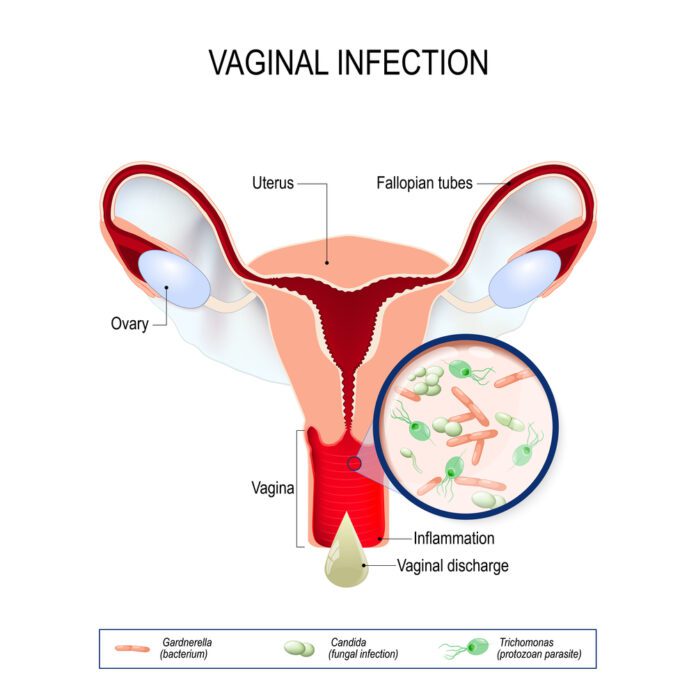 Vaginal Yeast Infections