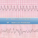 Ventricular Tachycardia