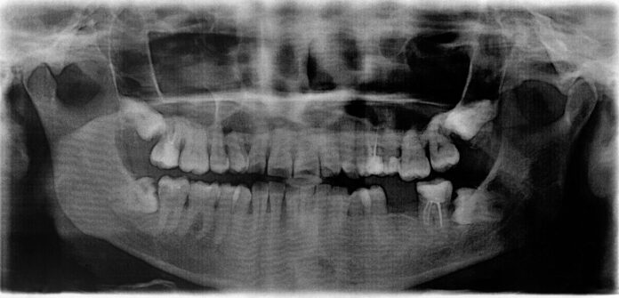 Impacted Tooth