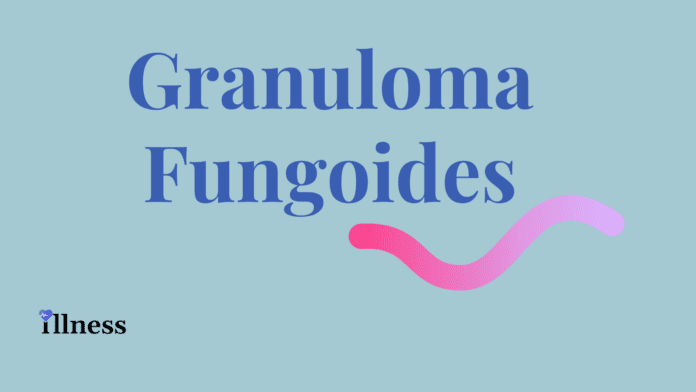 Granuloma Fungoides