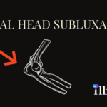 Radial Head Subluxation