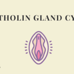 Bartholin's Gland Cyst