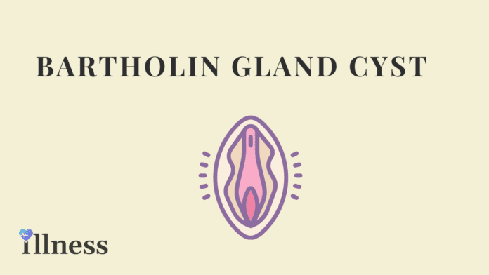 Bartholin's Gland Cyst