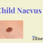 Child Naevus