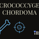 Sacrococcygeal Chordoma
