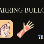 Scarring Bullosa