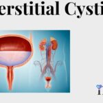 Interstitial Cystitis (IC)
