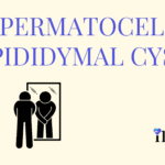 Spermatocele (Epididymal Cyst)
