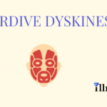 Tardive Dyskinesia
