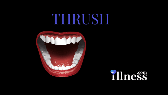 Thrush