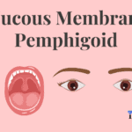 Mucous Membrane Pemphigoid