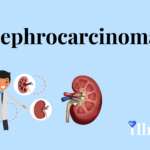 Nephrocarcinoma