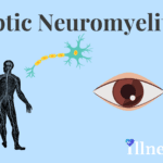 Optic Nerve Atrophy