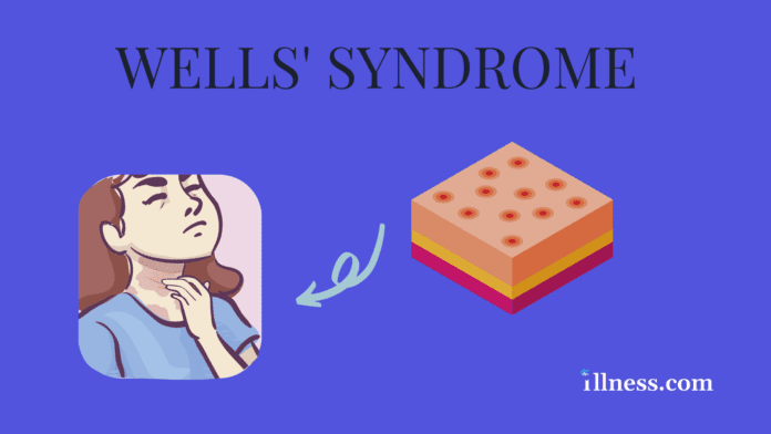 Muckle-Wells Syndrome