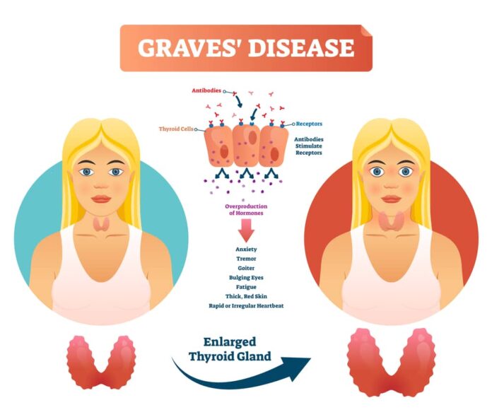 Grave's Disease