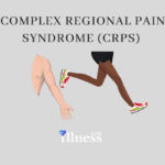 Complex Regional Pain Syndrome (crps)