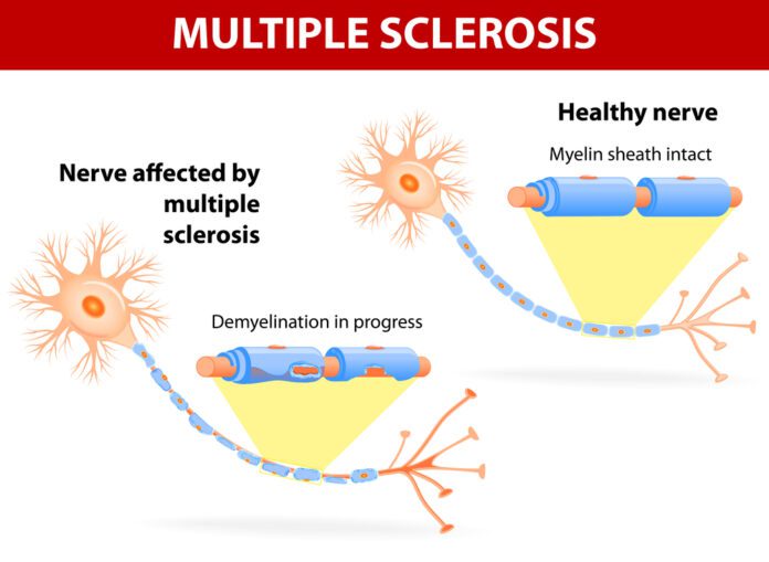 Multiple Sclerosis Treatment: Types Of Treatment & Benefits