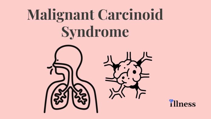 Malignant Carcinoid Syndrome